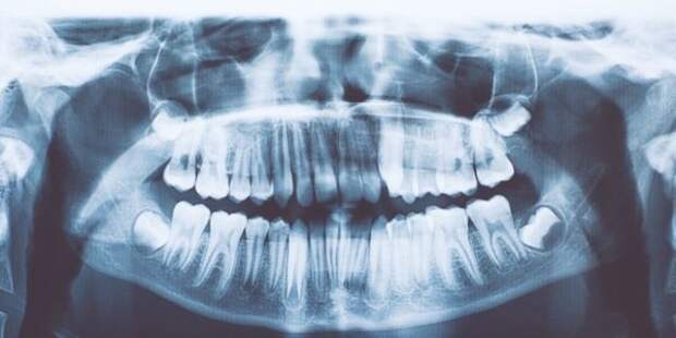 У индийского мальчика найдено 526 лишних зубов. Что это за болезнь
