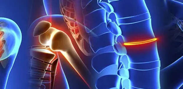 Спондилез позвоночника: что это такое, как проявляется и где лечить в Санкт-Петербурге