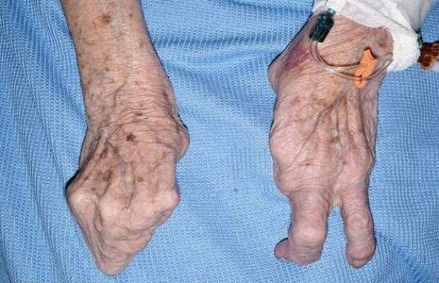 94-летняя бабушка-лобстер наповал сразила врачей 94-летняя бабушка-лобстер наповал сразила врачей