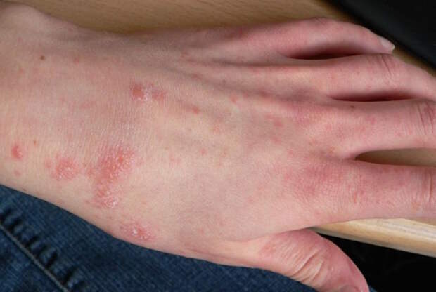 naturall-antihistamine-