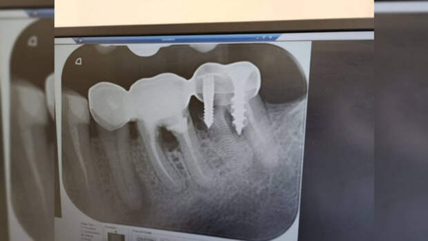 Стоматолог обнаружил у пациента зуб, прикрученный на саморез