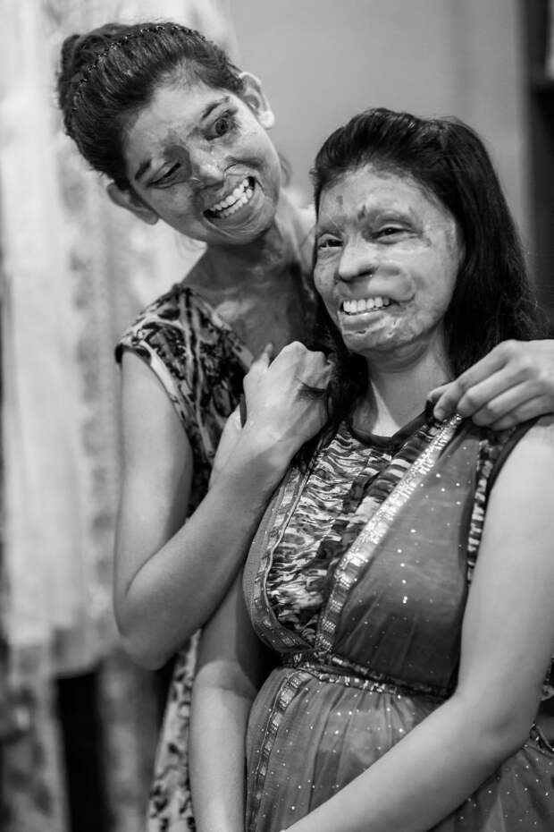 Портреты и истории людей, которые стали жертвами кислотных атак