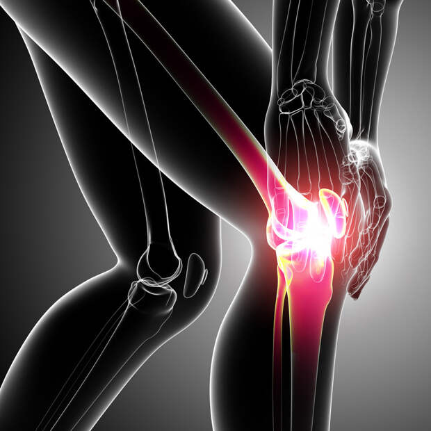 Причины развития и лечение деформирующего остеоартроза коленного сустава (гонартроза)
