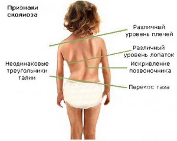причины сколиоза у детей