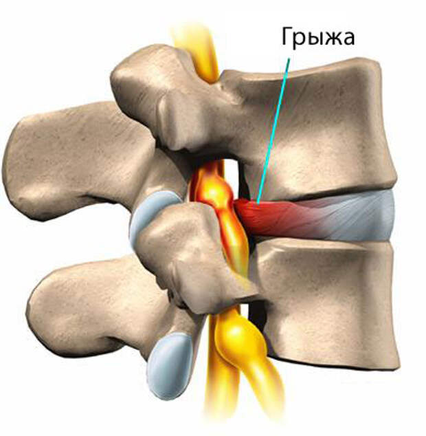 Межпозвоночная грыжа