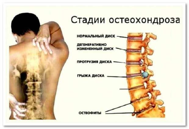 Остеохондроз: Самый ПРОСТОЙ метод лечения