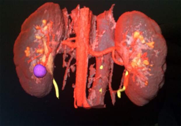Сначала врачи получают 3D модель почки и точно видят место, где находится злокачественная опухоль (на рисунке она фиолетового цвета).