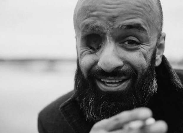 Лишившийся глаза майданщик Найем требует от украинцев последовать его примеру