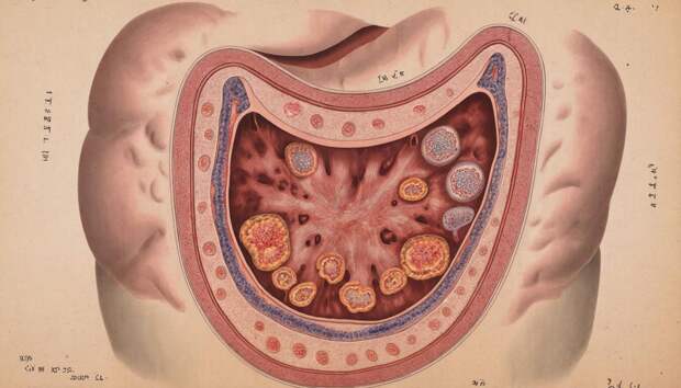 Онколог Черемушкин назвал ранние симптомы рака желудка