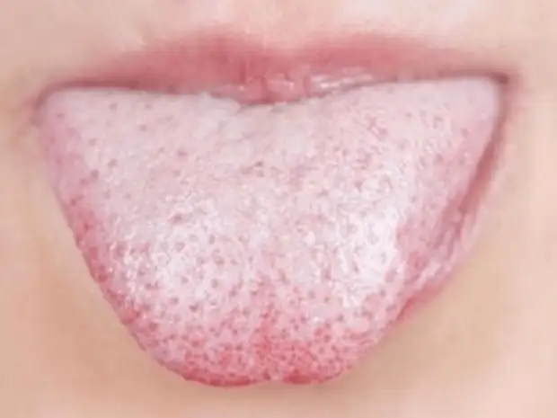 Что расскажет язык о вашем здоровье