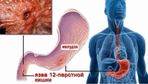 Боли при язве: причины, симптомы, особенности диагноза, лечение, восстановительный период и консультации врача