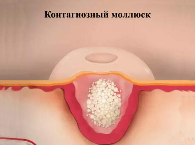 Как победить вирусную кожную болезнь (моллюск) у детей и взрослых без боли и шрамов