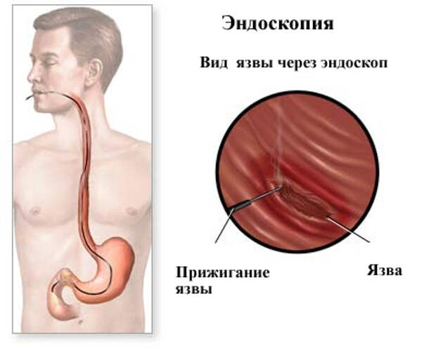 Эндоскопия пищевода. Язвенная болезнь желудка ФГДС. ФГДС двенадцатиперстной кишки. Язвенная болезнь ДПК ФГДС.