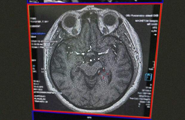 В ОКБ помогли пенсионерке, перенесшей инсульт из-за нездорового образа жизни