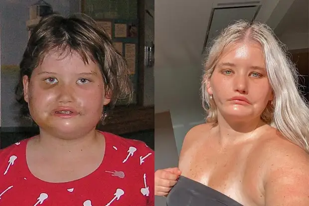 Всегда грустная: как выглядит девушка, которая ни разу в жизни не улыбалась, — она стала моделью, несмотря на редкую болезнь