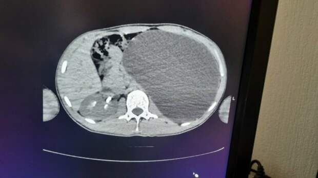 Размером с пятилитровую бутылку. Под Новосибирском подростку удалили гигантскую почку
