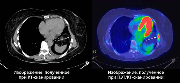 КТ и ПЭТ-КТ при онкологии: что выбрать и почему это важно