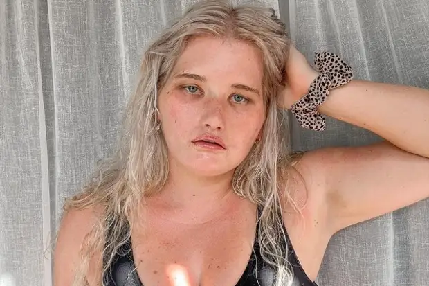 Всегда грустная: как выглядит девушка, которая ни разу в жизни не улыбалась, — она стала моделью, несмотря на редкую болезнь