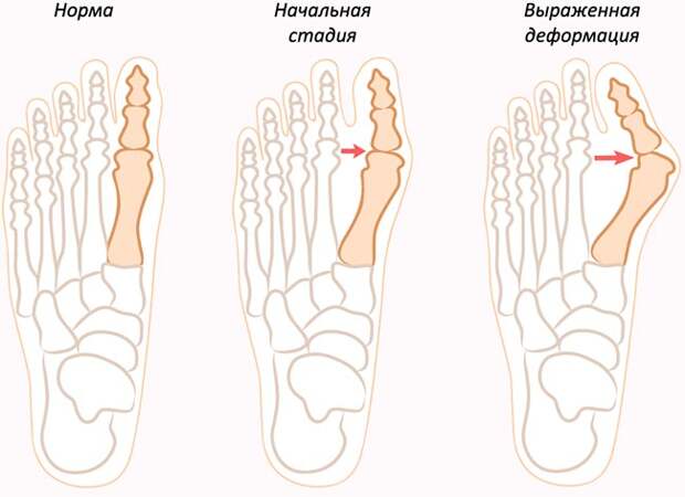 стадии вальгусной деформации стопы (шишки на пальце ноги)