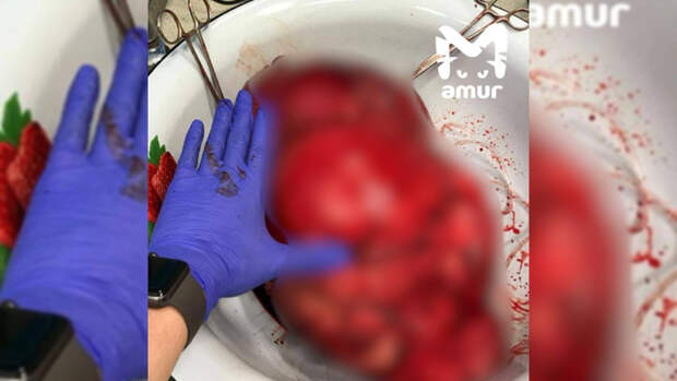 Во Владивостоке провели операцию по удалению опухоли величиной с два шара для боулинга