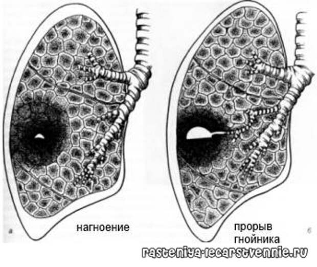 Абсцесс легкого: о лечении, симптомах, диагностике, лечении народными средствами