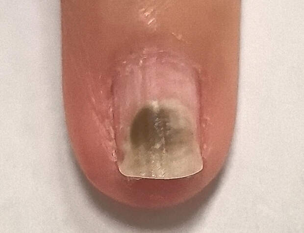 Врач Лавров: подногтевая меланома не сдвигается по мере роста ногтя