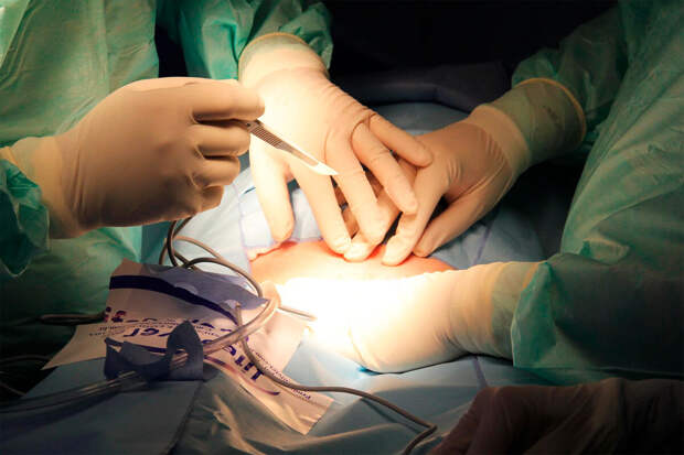 В Улан-Удэ врачи спасли любительницу слив с камнем в желудке