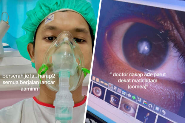 WOB: мужчине из Малайзии пересадили роговицу, потому что он часто тер свой глаз