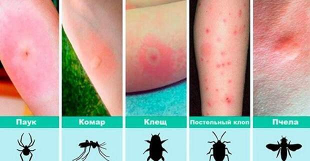 12 видов укусов насекомых и что делать при каждом из них (часть 1) 0