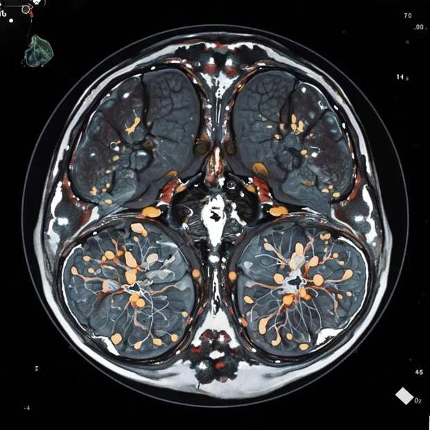Магнитно-резонансная томография при диагностике нейродегенеративных заболеваний