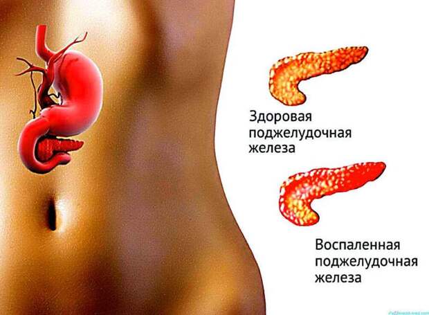 Панкреатит: Простые способы очищения поджелудочной железы Панкреатит: Простые способы очищения поджелудочной железы