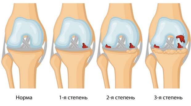 Артроз I, II, III степени