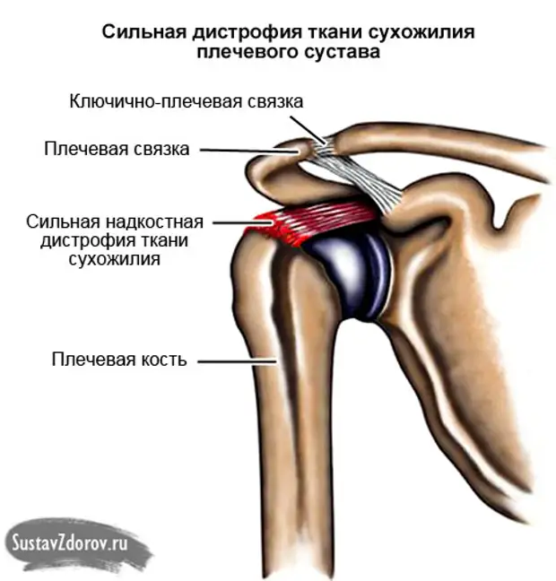 Сильные боли в плечевом суставе левой руки. Тендинит плечевого сухожилия. Кальцинирующий бурсит плечевого сустава. Тендинит — воспаление сухожилий плечевого сустава;. Кальцинирующий тендинит плечевого сустава рентген.