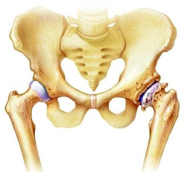 Коксартроз тазобедренного сустава 