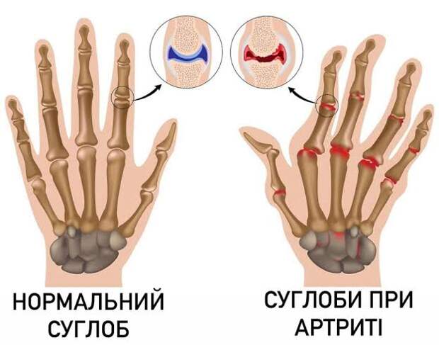 Анализы при артрите: какие сдать, расшифровка показателей и нормы | Полный обзор
