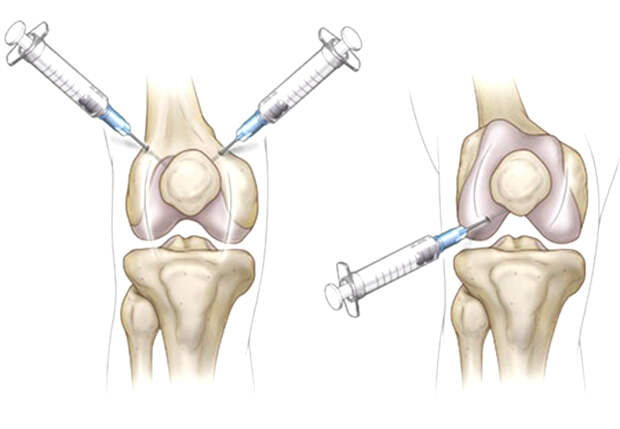 Внутрисуставные инъекции: виды, показания, последствия и отзывы | Полный обзор