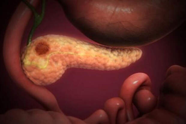 RevMed: новый препарат блокирует главную мутацию-провокатор рака поджелудочной