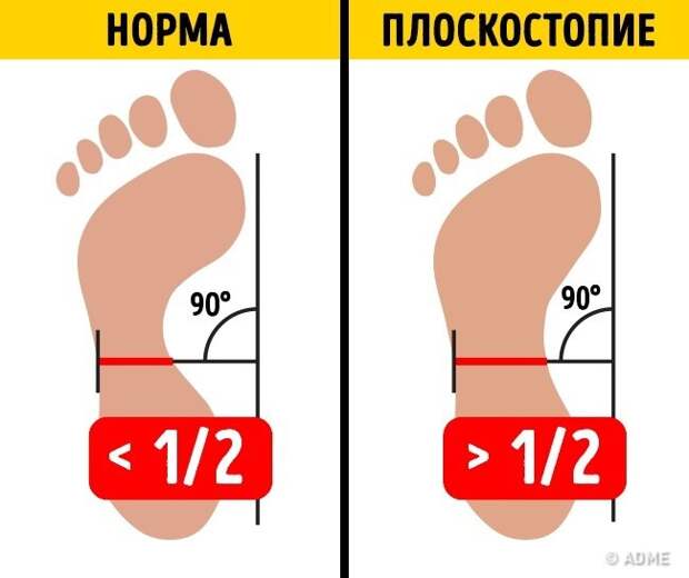 Всего 2 упражнения, и плоскостопие вас не побеспокоит Всего 2 упражнения, и плоскостопие вас не побеспокоит