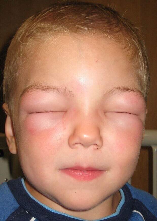 Как Аллергия может Вас убить | Что такое отёк Квинке?