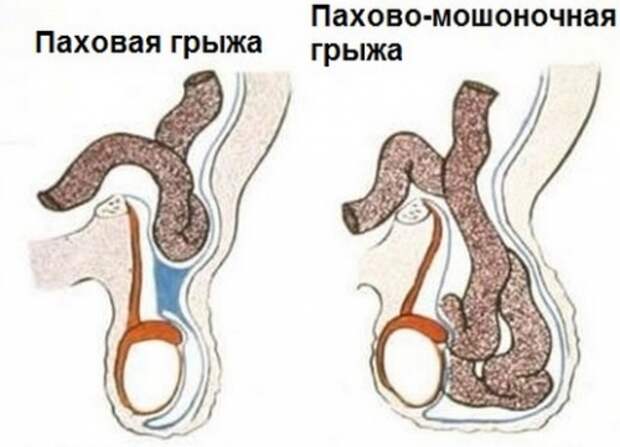 Уплотнение в мошонке: возможные причины, симптомы, лечение