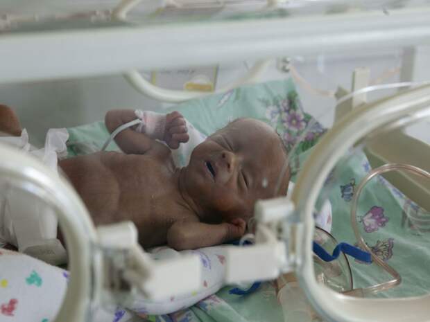 В Тюменской области на свет появились дети без почек