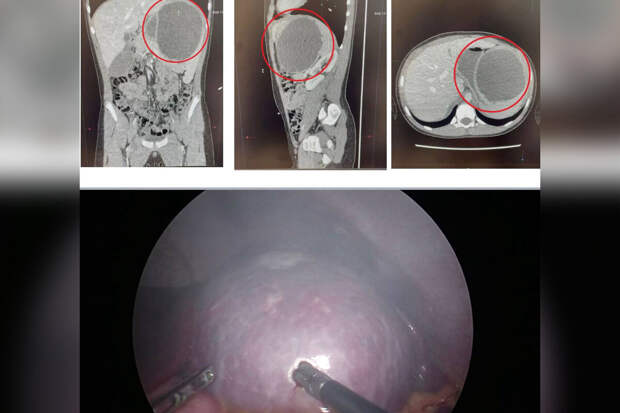 В Подмосковье врачи спасли школьника с редкой кистой селезенки