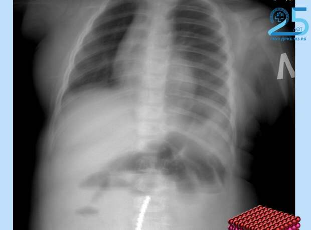 В Бурятии спасли ребенка, наглотавшегося магнитов