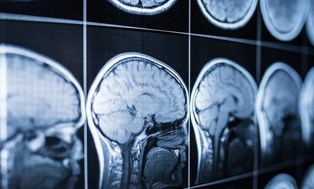 Ученые расшифровали активность мозга умирающего человека и удивились