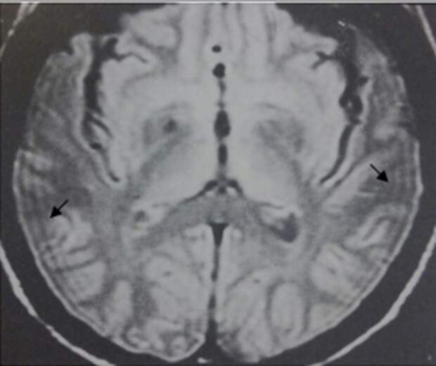 Химический сдвиг в МРТ: диагностика, ценность и методы коррекции артефакта