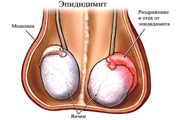 Уплотнение в мошонке: возможные причины, симптомы, лечение