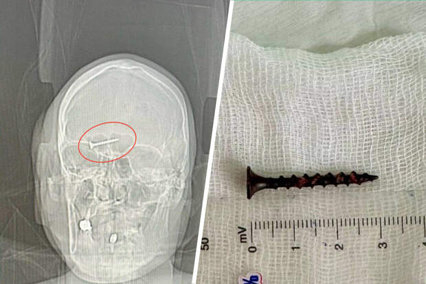 В Петербурге врачи спасли мужчину с шурупом и резиновым шариком в голове