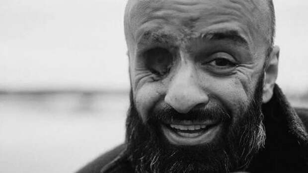 Лишившийся глаза майданщик Найем требует от украинцев последовать его примеру