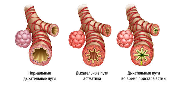 Будесонид + Формотерол или Салметерол + Флутиказон