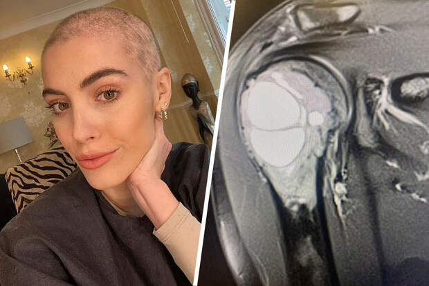 Daily Mail: боль в плече девушки была вызвана раковой опухолью размером с авокадо